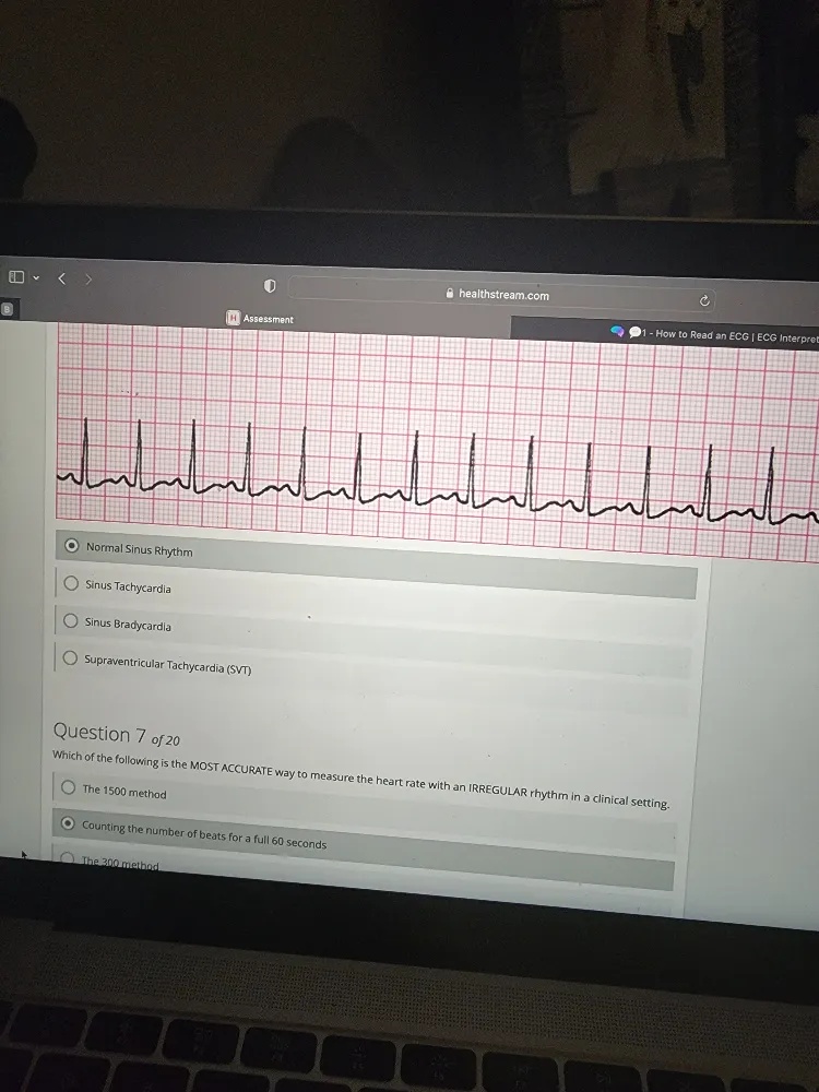 Svt In Normal R R Intervel Normal Sinus Rhythm Sinus Tachycardia Sinus | StudyX