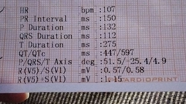 HR bpm107 PR Interval ms 150 P Duration ms | StudyX