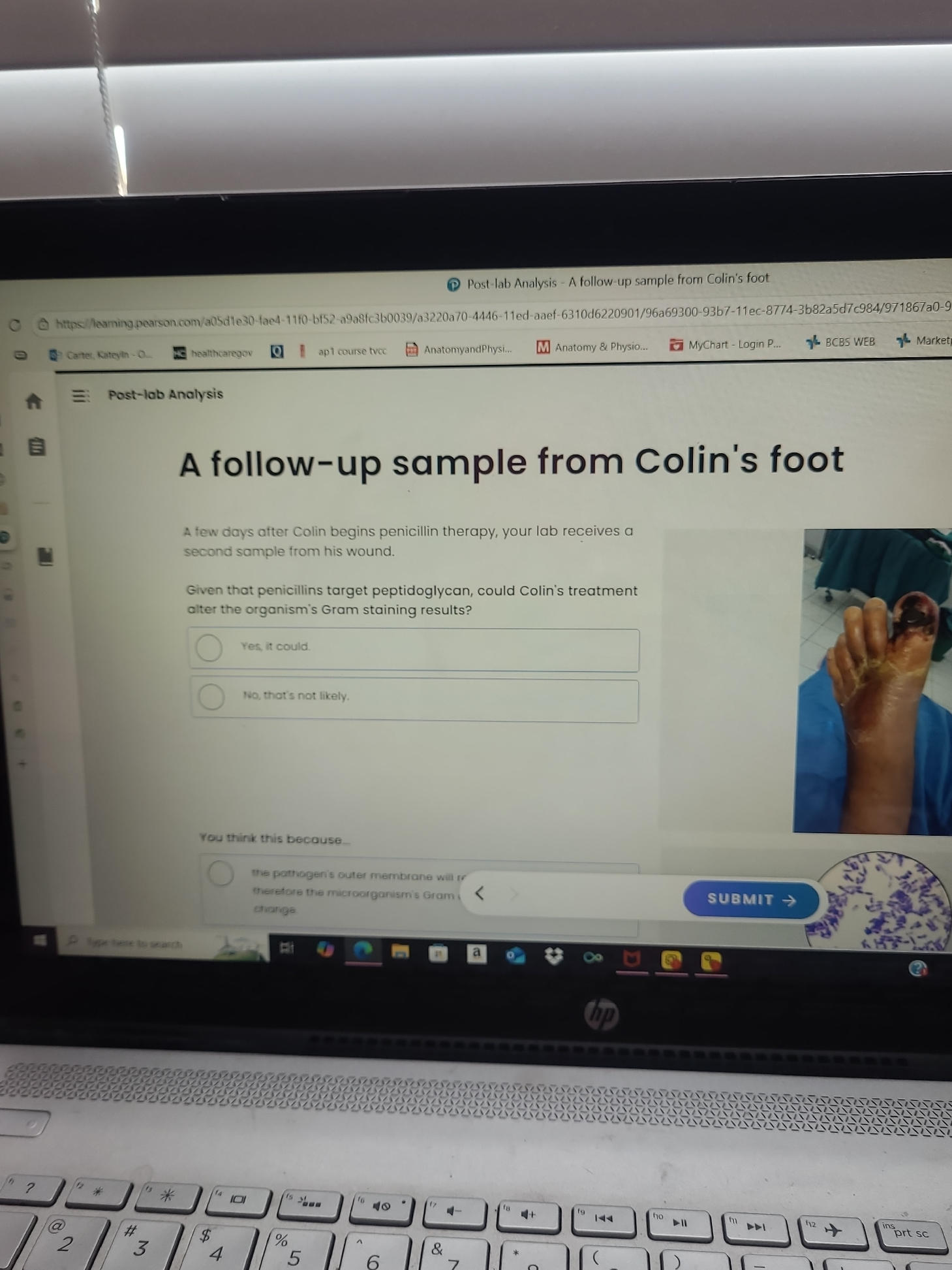 A follow-up sample from Colin's foot A few