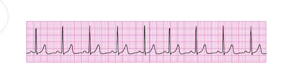 The image shows an ECG tracing. The | StudyX