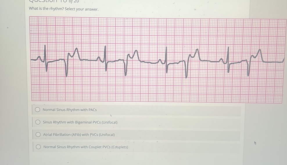 What is the rhythm? Select your answer. | StudyX