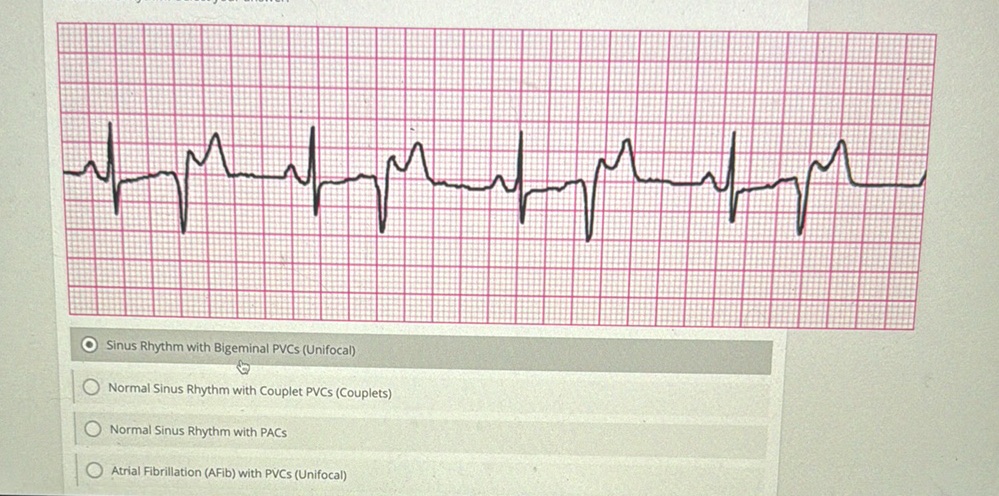 Normal Pvc Sinus Rhythm with Bigeminal PVCs (Unifocal) | StudyX
