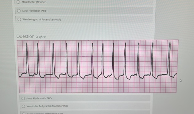 Atrial Flutter (AFlutter) Atrial | StudyX