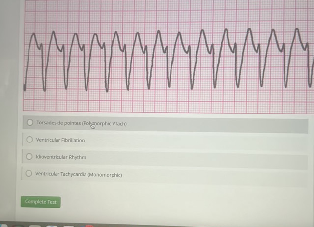 Torsades de pointes (Polymorphic VTach) | StudyX