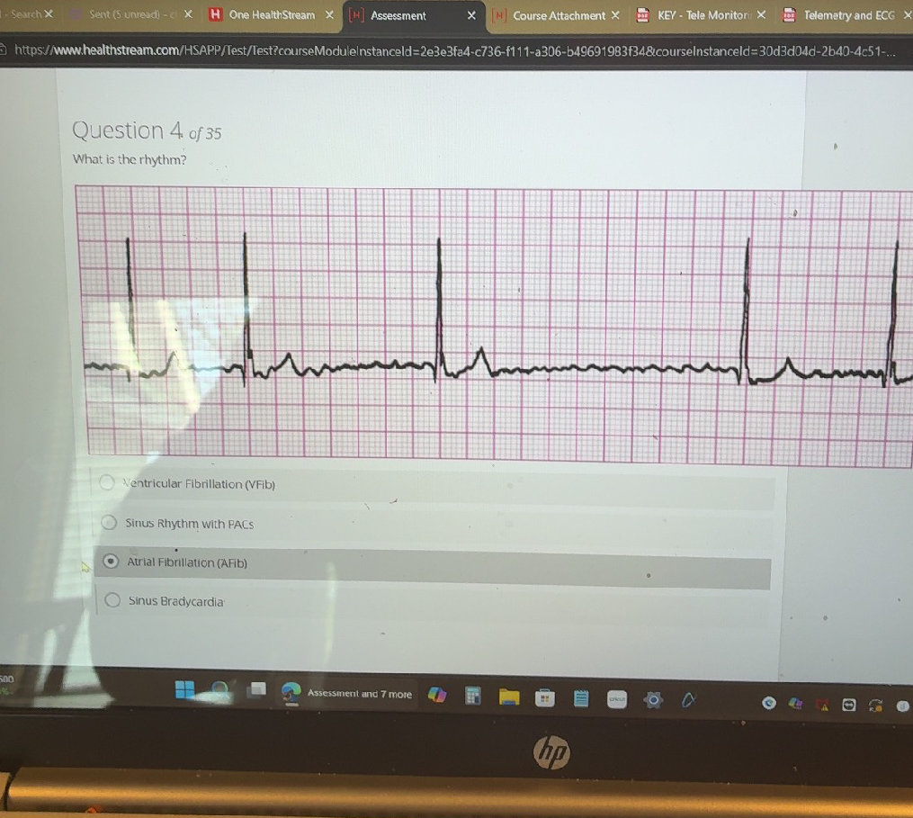 What is the rhythm? Ventricular Fibrillation