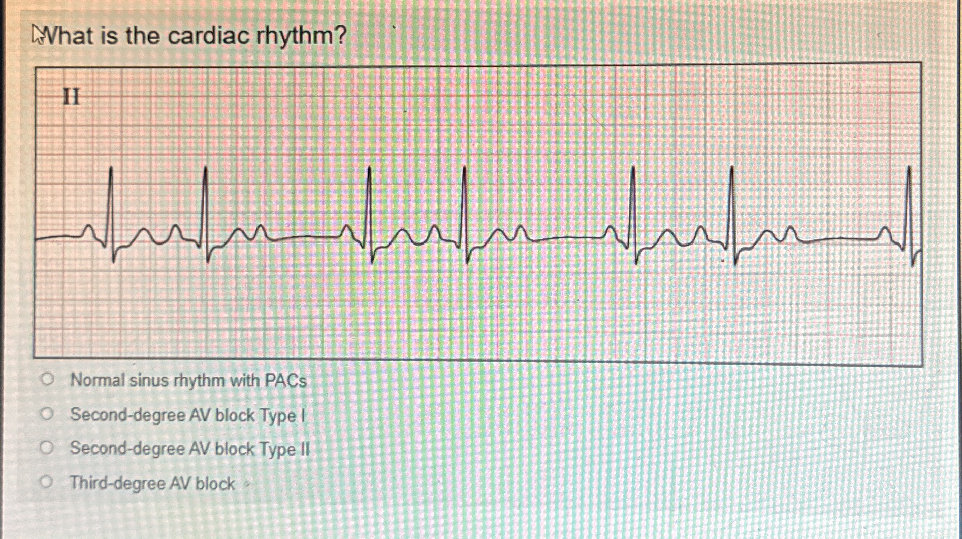 What is the cardiac rhythm? Normal sinus | StudyX