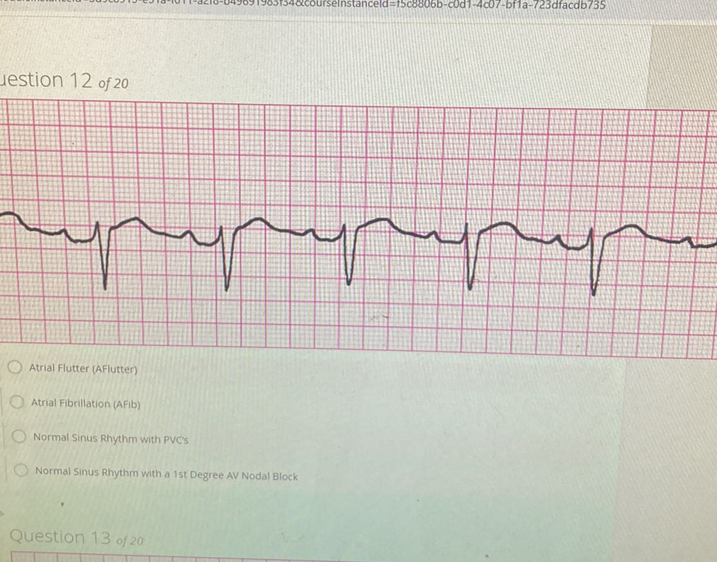 Atrial Flutter (AFlutter) Atrial