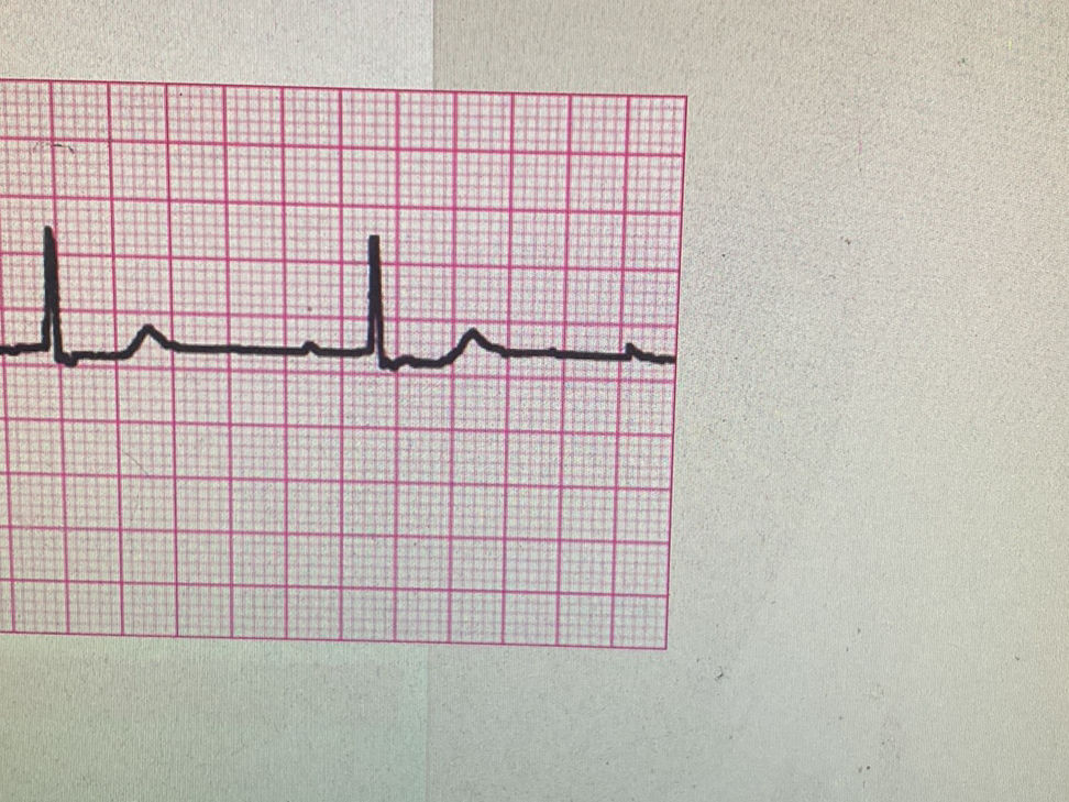 The image shows an ECG tracing. The | StudyX