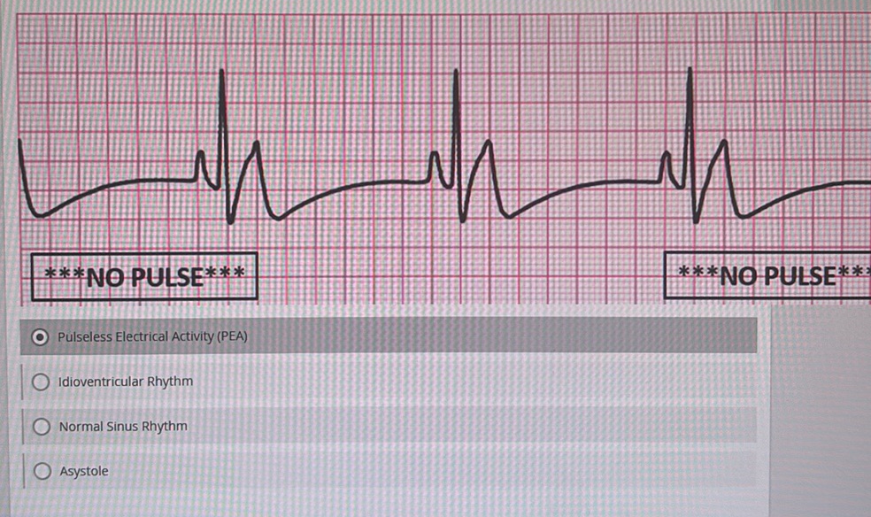 ***NO PULSE*** Pulseless Electrical | StudyX